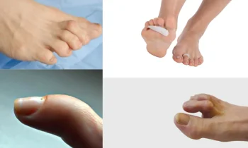 Çekiç Parmak İçin Ortopedik Destek Ürünleri Hangileridir?